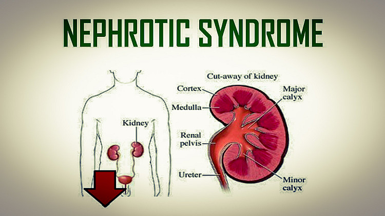 Treatments of nephrotic syndrome