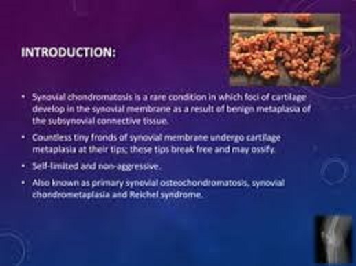 joint cell tumor and its treatments