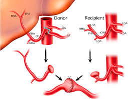 Liver transplant radiology